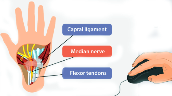 Carpal Tunnel Syndrome