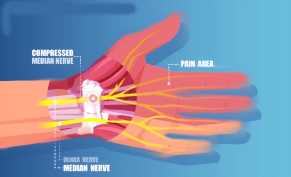 Carpal Tunnel Syndrome