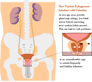 Prostate Cancer