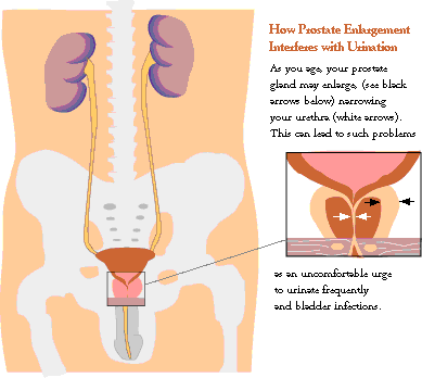 Prostate Cancer 