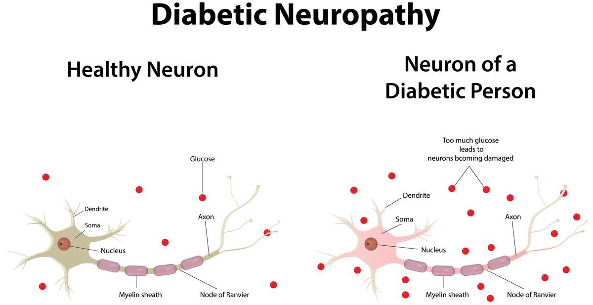 Effective Strategies To Treat Diabetic Neuropathy A Comprehensive Guide effective-strategies-to-treat-diabetic-neuropathy-a-comprehensive-guide